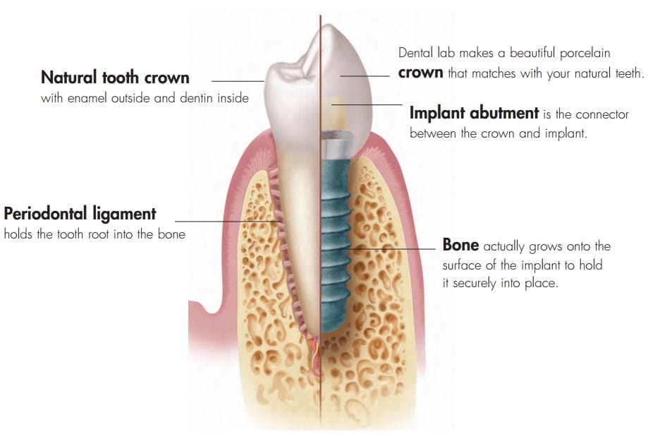 dental-implant-information-rd-dental